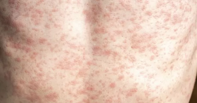Giroir: RFK Jr. Needs to 'Unconditionally' Advocate for Measles Vaccine, Lack of Vaccination Causing Deaths, Outbreak