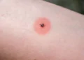 NHS list of 14 different insect bites, their symptoms and how to treat them