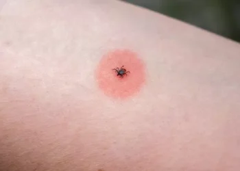 NHS list of 14 different insect bites, their symptoms and how to treat them