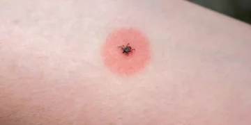 NHS list of 14 different insect bites, their symptoms and how to treat them