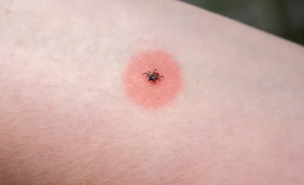 NHS list of 14 different insect bites, their symptoms and how to treat them