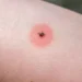 NHS list of 14 different insect bites, their symptoms and how to treat them
