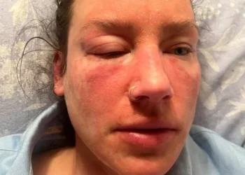 My skin is constantly on fire and I look like a burns victim because of a common cream, this might last years