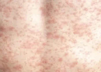 Giroir: RFK Jr. Needs to ‘Unconditionally’ Advocate for Measles Vaccine, Lack of Vaccination Causing Deaths, Outbreak