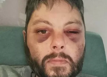 Artist’s bruised face after partner’s two-hour attack that killed him
