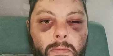 Artist’s bruised face after partner’s two-hour attack that killed him