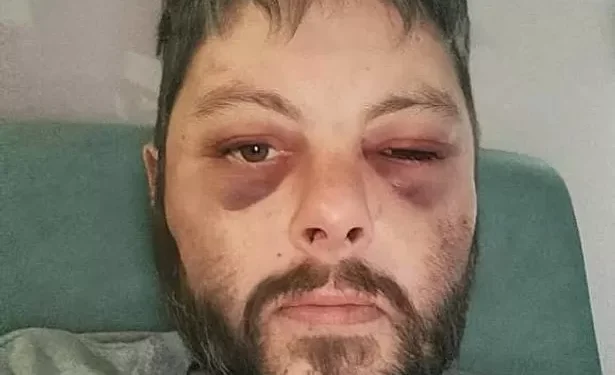 Artist’s bruised face after partner’s two-hour attack that killed him
