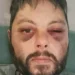 Artist’s bruised face after partner’s two-hour attack that killed him